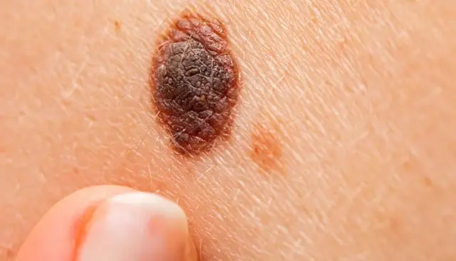 Melanoma