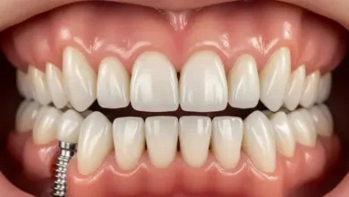 Individual Tooth Replacement Using Advanced Implant Techniques
